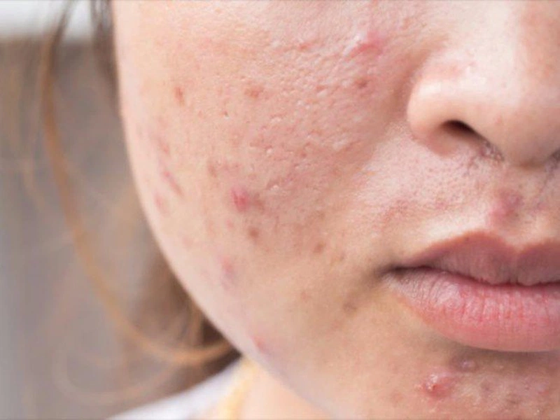 Đa nang buồng trứng gây mụn: Mối liên quan và cách điều trị 2