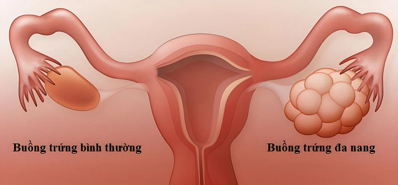 Đa nang buồng trứng uống thuốc tránh thai có tác dụng gì? 1
