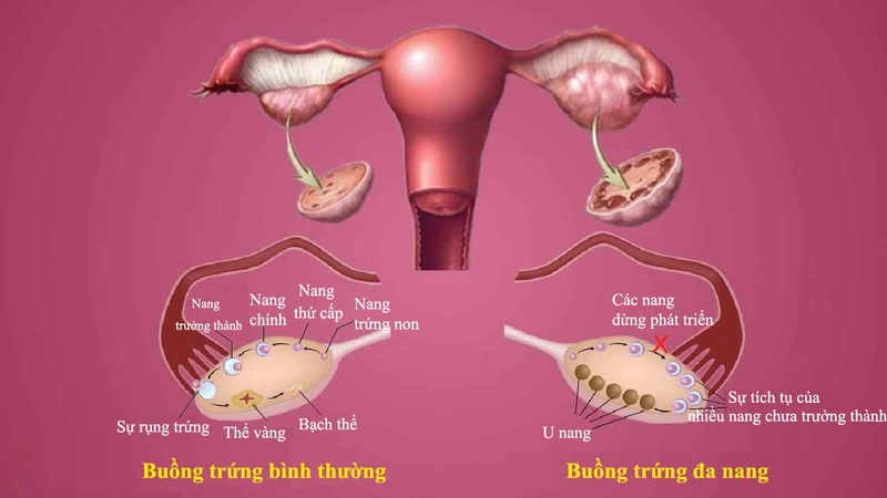 Đa nang buồng trứng uống vitamin E được không? 1