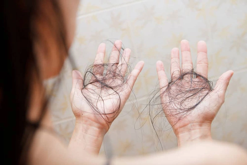 Ở giai đoạn 2, bệnh nhân có các biểu hiện đặc trưng như rụng tóc