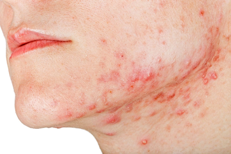 Mụn ở quai hàm: Đặc điểm và cách điều trị mụn hiệu quả 1