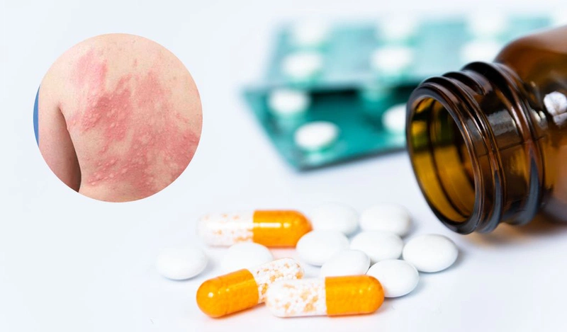 Đặc điểm nhận dạng mề đay nhiễm trùng để điều trị kịp thời 3