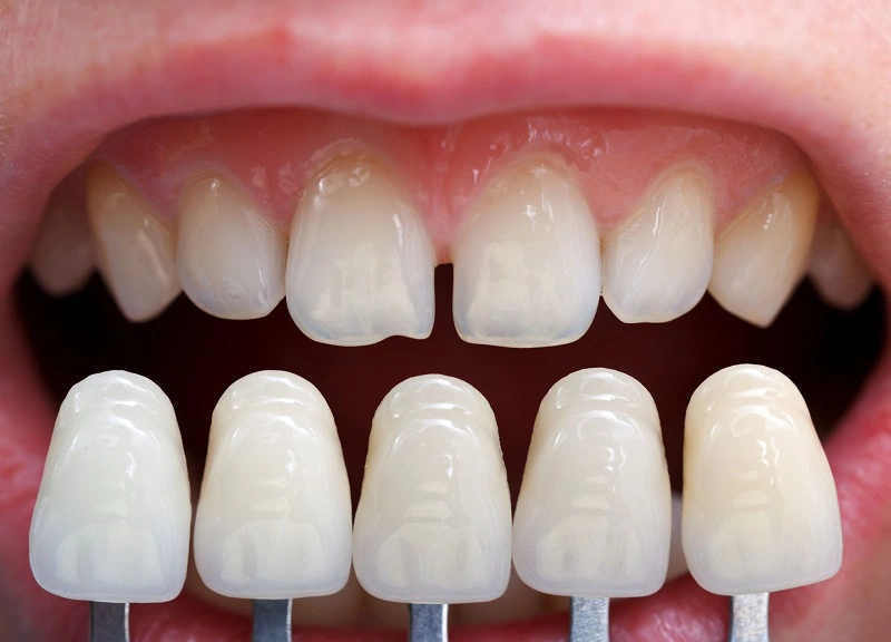 Thông tin về dán sứ Veneer