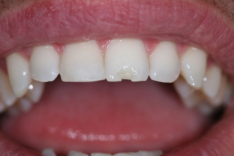 Dán sứ veneer là gì? Dán sứ veneer có bền không?1