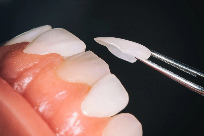 Giải đáp thắc mắc: Dán sứ veneer có ảnh hưởng gì không? 1