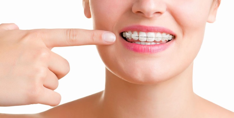 Dán veneer có niềng răng được không? Dán veneer hay bọc sứ tốt hơn? 2
