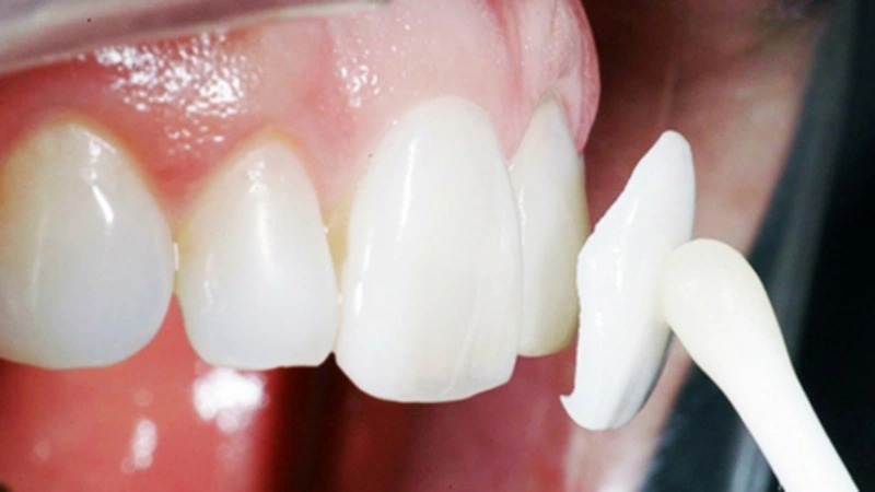 Nên dán sứ veneer hay bọc răng sứ? Cái nào tốt hơn? 3