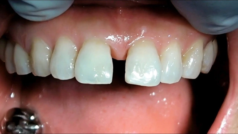 Dán veneer răng thưa là gì? Đối tượng nào phù hợp với phương pháp này? 1
