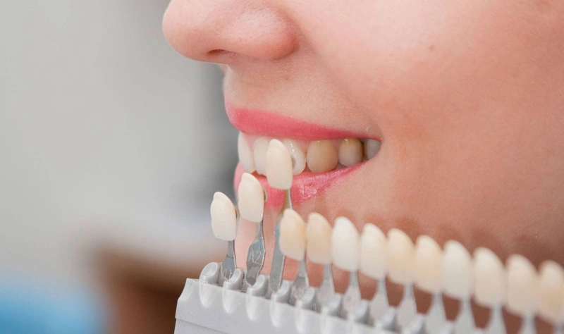 Dán veneer răng thưa là gì? Đối tượng nào phù hợp với phương pháp này? 2