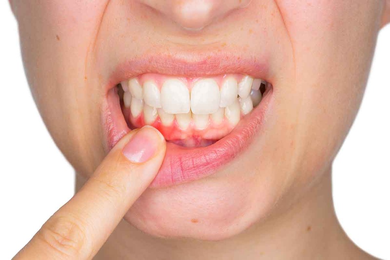 Nước súc miệng chữa tụt lợi hỗ trợ ngăn tình trạng tụt lợi thêm nặng