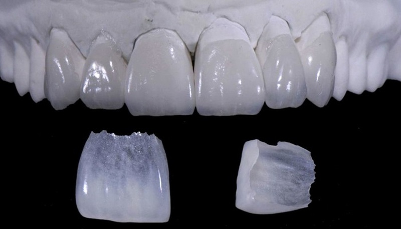 Dán sứ veneer diamond có tốt không? Chi phí thế nào? 2