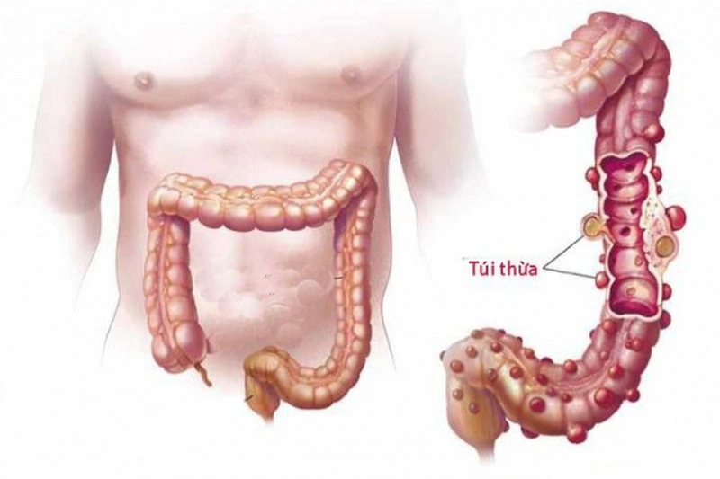đau bụng dưới bên trái gần háng là dấu hiệu của bệnh gì 3