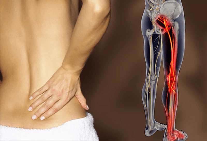 Đau căng cơ mông: Nguyên nhân và cách chữa trị 1