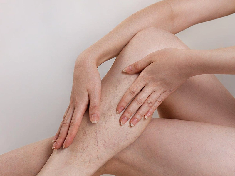 Giải đáp thắc mắc: Dầu dừa có trị giãn tĩnh mạch không?  1