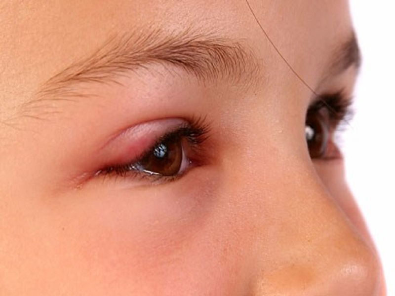 Dấu hiệu bị đau mắt đỏ và cách điều trị 2