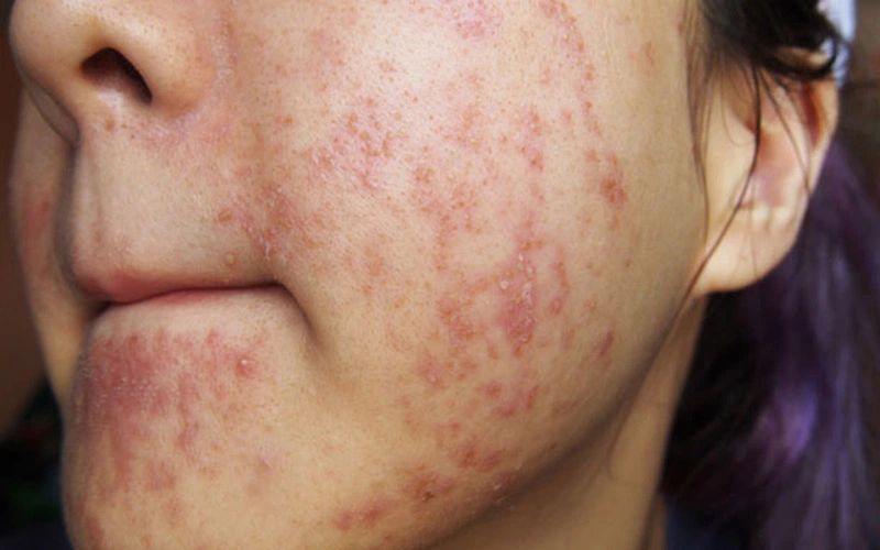 Trả lời cho câu hỏi: Dị ứng da mặt có để lại sẹo không?  1
