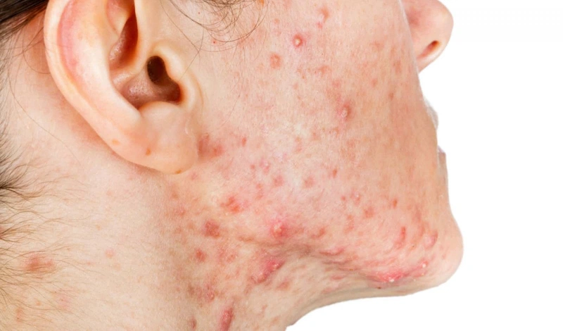 Dấu hiệu bị mụn nội tiết và cách chăm sóc da mụn 1