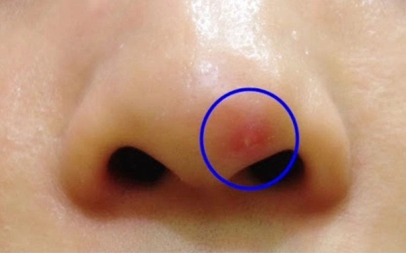 Dấu hiệu mưng mủ sau khi nâng mũi