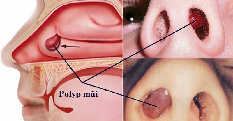 Dấu hiệu bị polyp mũi dễ nhận biết và cách phòng ngừa 1