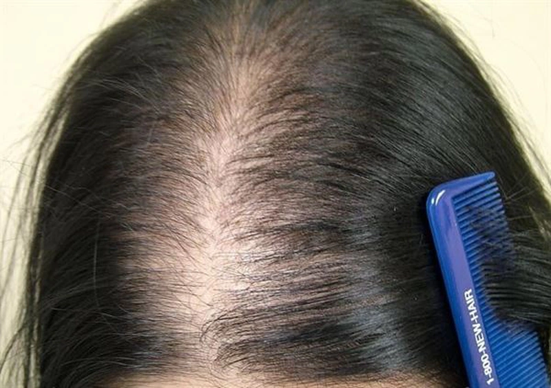 Vấn đề rụng tóc trong điều trị ung thư1