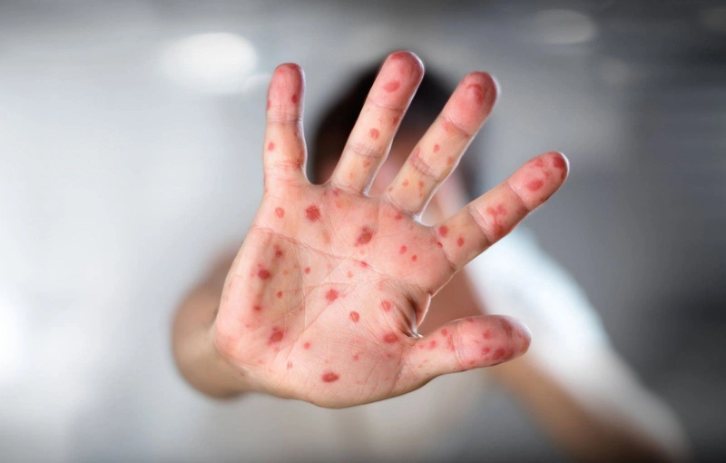 Dấu hiệu các nốt sởi và phân biệt với sốt phát ban 3