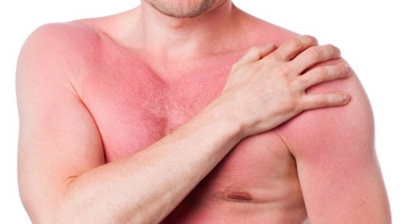 Dấu hiệu của bệnh dị ứng thời tiết và biện pháp điều trị hiệu quả 1