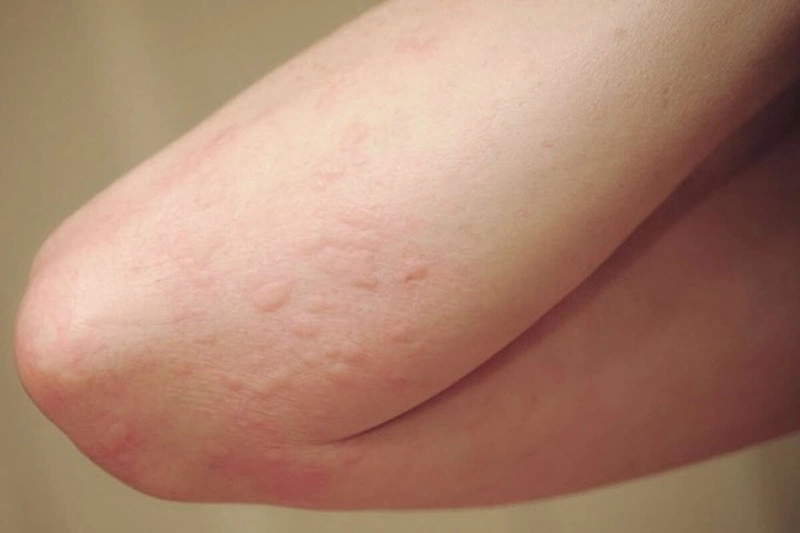 Dấu hiệu HIV ở nữ là gì? Thời điểm nào cần xét nghiệm HIV ở nữ giới 2