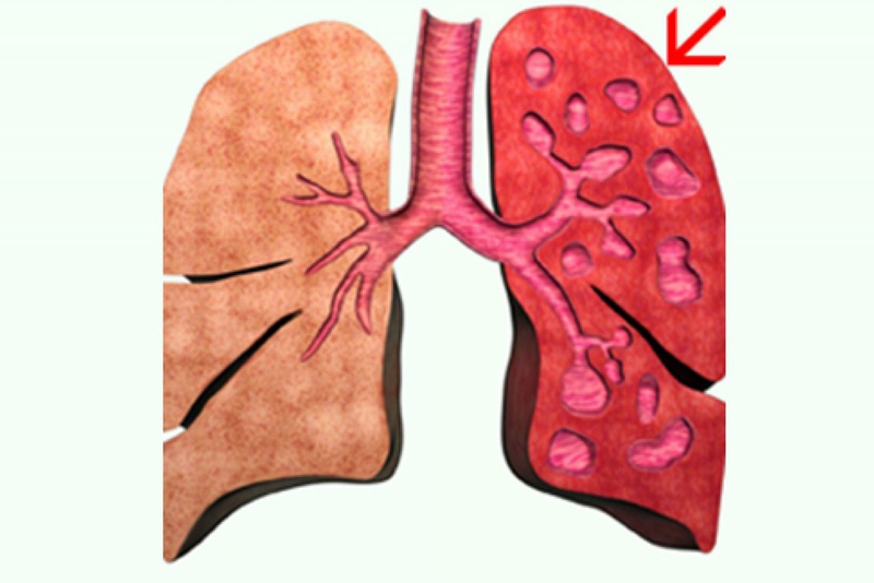 Giãn phế quản thường do di chứng của bệnh lao phổi hoặc do nhiễm trùng phổi mãn tính