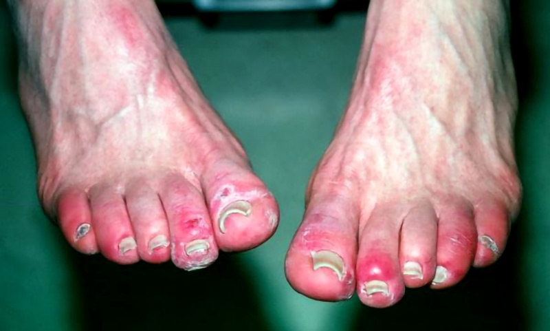 Cước chân vào mùa đông là một trong những bệnh ngoài da phổ biến