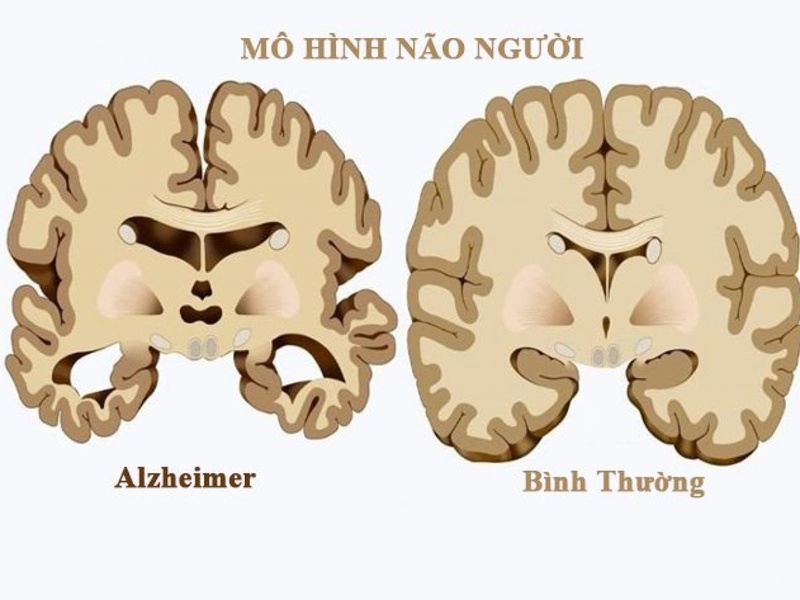 Dấu hiệu nhận biết bệnh alzheimer giai đoạn đầu và cách phòng tránh 1