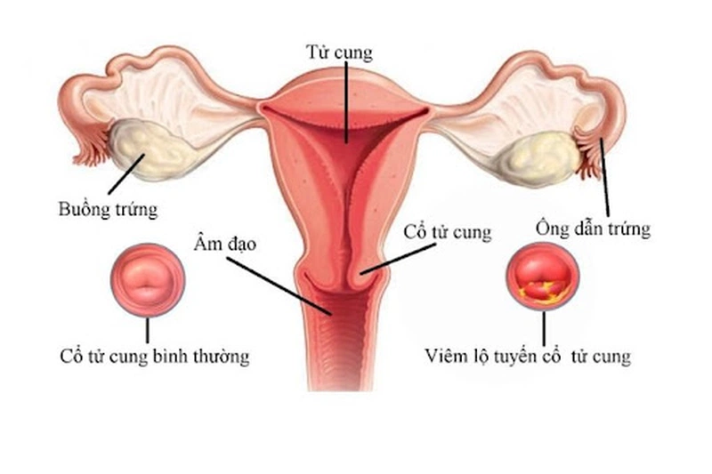 Dấu Hiệu Nhận Biết Cổ Tử Cung Ngắn Mà Bạn Nên Biết 1