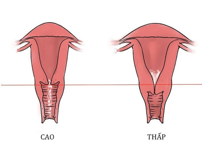 Dấu Hiệu Nhận Biết Cổ Tử Cung Ngắn Mà Bạn Nên Biết 2