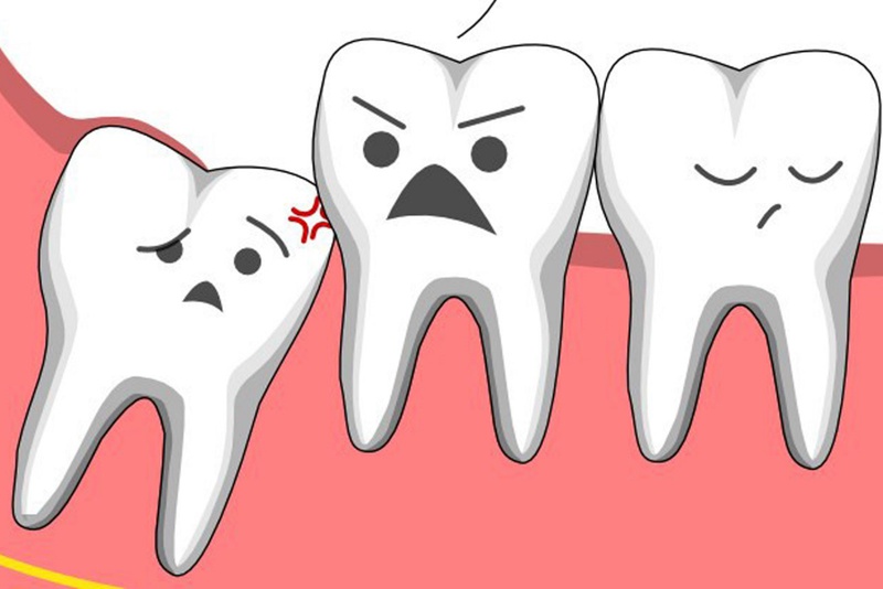 Dấu hiệu nhận biết răng khôn mọc lệch 2