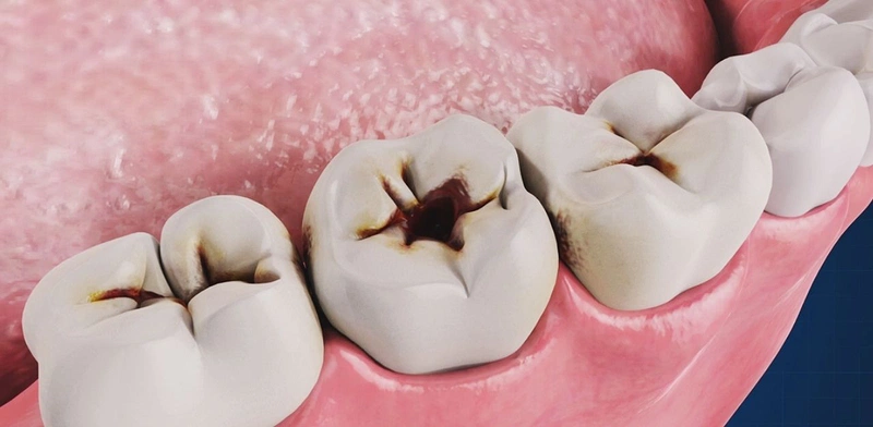 Dấu hiệu nhận biết và điều trị đúng viêm tủy răng có mủ 1