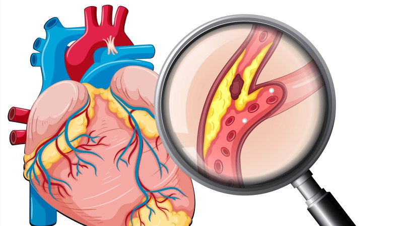 Khi lượng mỡ trong máu tăng cao, hệ thống động mạch sẽ bị ảnh hưởng nhiều nhất