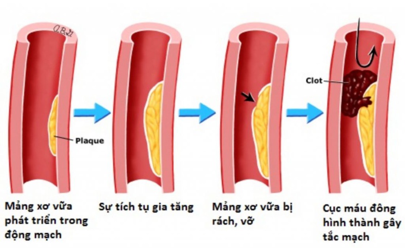  Đau thắt ngực là dấu hiệu điển hình của bệnh động mạch vành