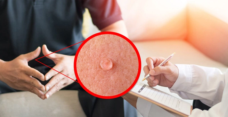 Dấu hiệu sùi mào gà ở nam giới giai đoạn đầu? Bệnh có tự hết không? 2
