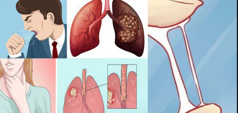 [Cảnh báo] Dấu hiệu ung thư phổi ở nam giới không nên bỏ qua 2