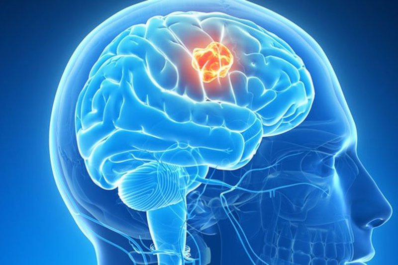Dấu hiệu và phương pháp chẩn đoán u sọ hầu ở trẻ em 1