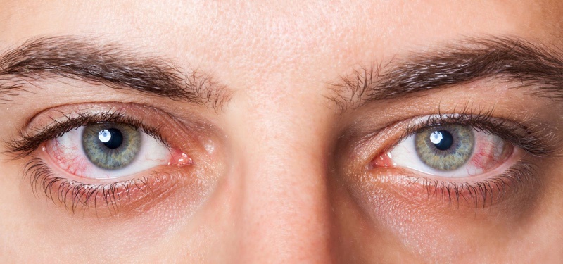Dấu hiệu và triệu chứng nhiễm trùng mắt1