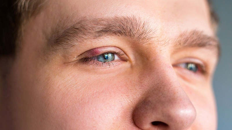 Dấu hiệu và triệu chứng nhiễm trùng mắt2