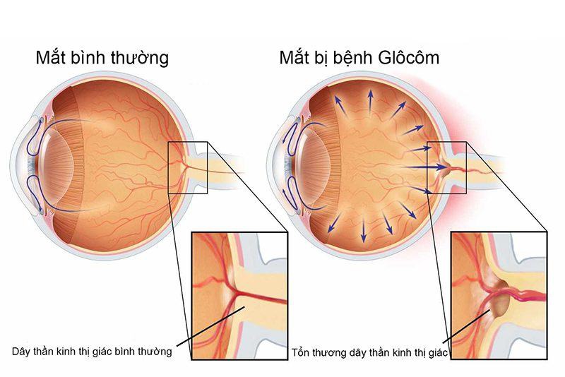 Đau hốc mắt là gì? Đau hốc mắt có nguy hiểm không? 5