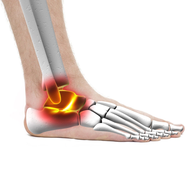 Khi dây chằng hoặc dây thần kinh quanh khớp cổ chân bị chèn ép có thể dẫn đến hội chứng ống cổ chân