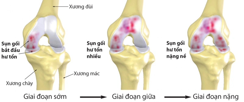 Đau khớp gối dấu hiệu bệnh gì? 1