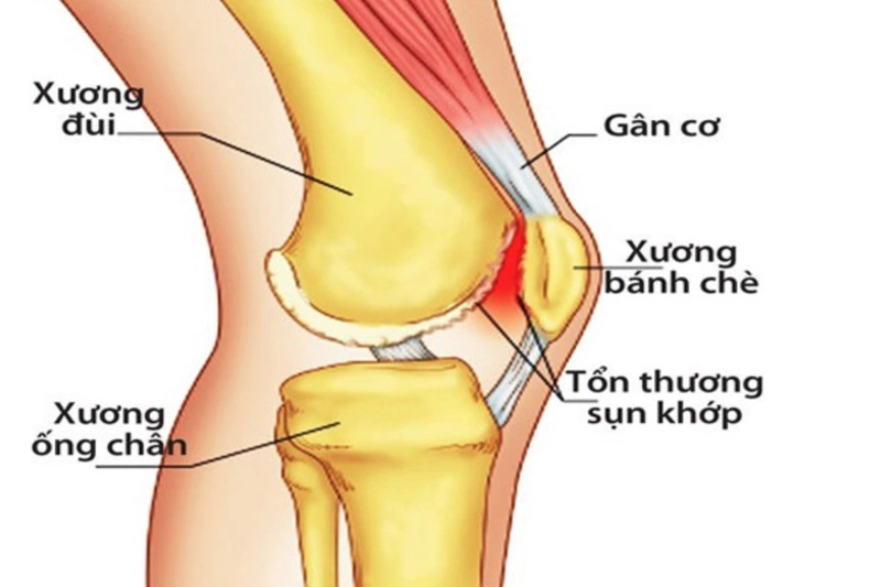 Đau khớp gối massage có hết không? 1