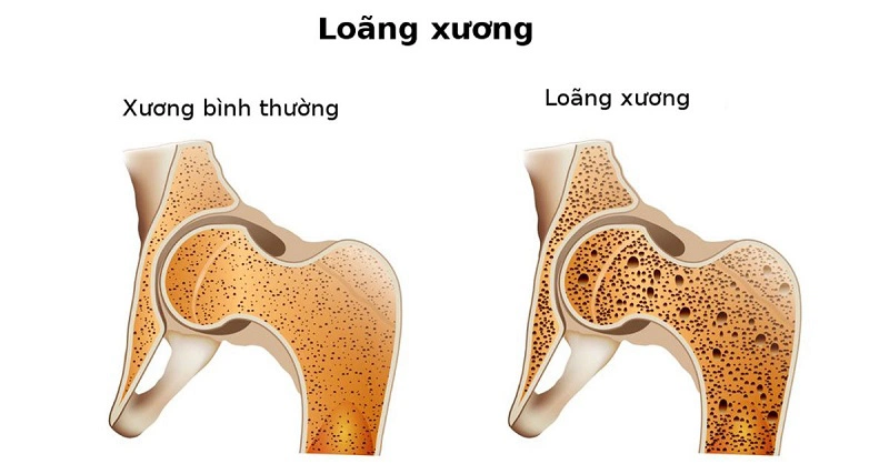 Loãng xương do thiếu dinh dưỡng cũng là một trong các nguyên nhân dẫn đến đau khớp gối