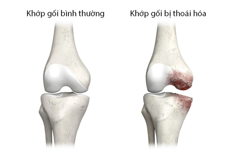 Thoái hóa khớp gối là một trong các nguyên nhân gây nên tình trạng đau khớp gối