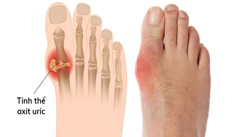 Đau khớp ngón chân cái bên phải là dấu hiệu bệnh gì 2