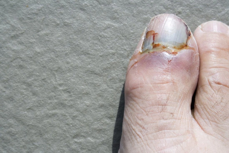 Đau khớp ngón chân cái trái là biểu hiện bệnh gì?1
