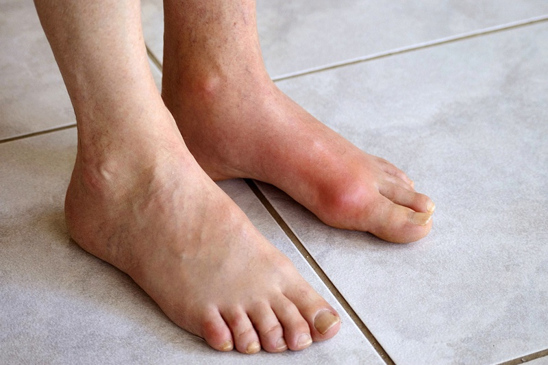 Đau khớp ngón chân cái trái là biểu hiện bệnh gì?2